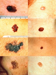 Why Americans Should Double their Concern About Melanoma