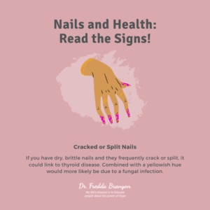 Cracked or Split Nails Image