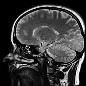 Is Brain Size A Risk Factor
